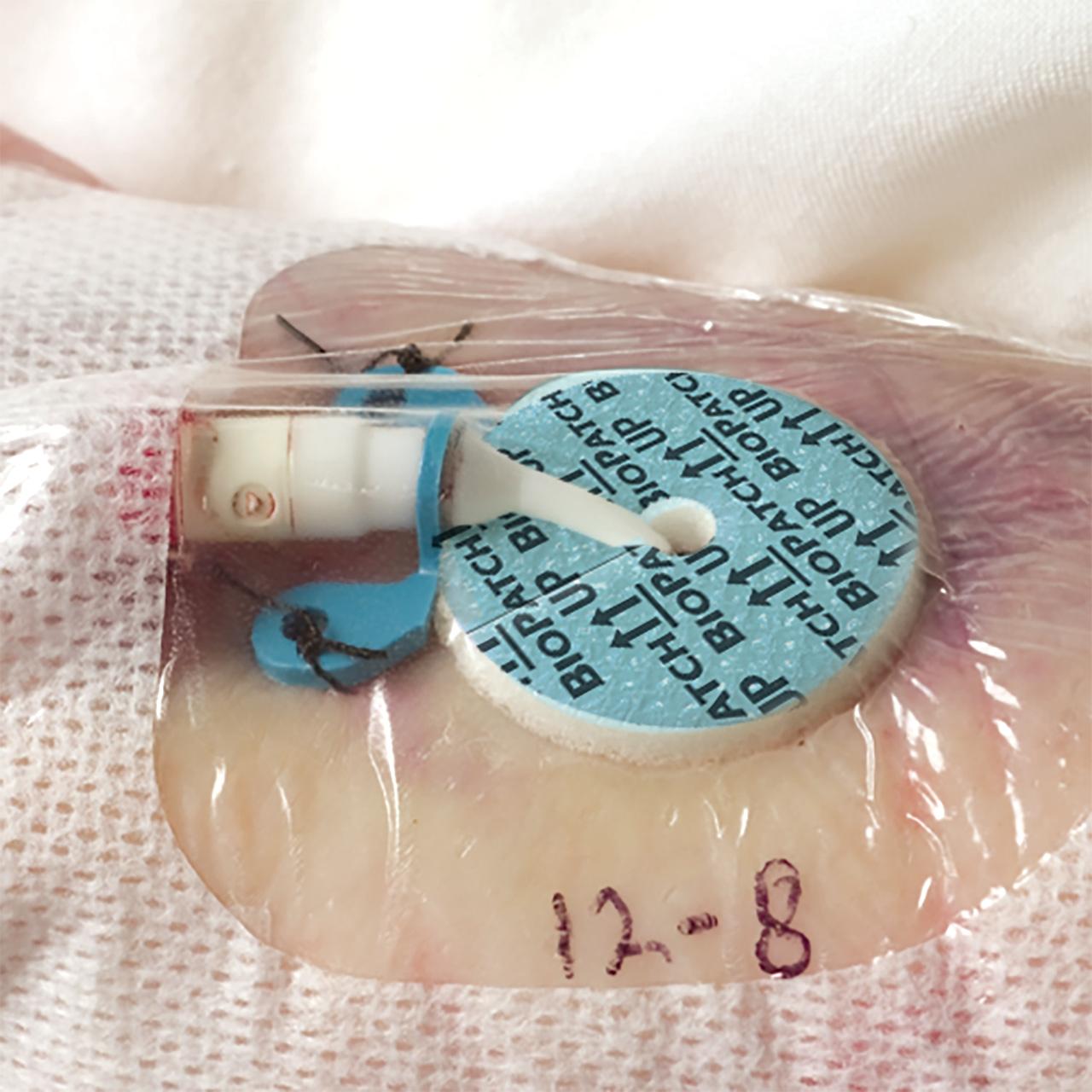 Biopatch Protective Disk With CHG - Box Of 50
